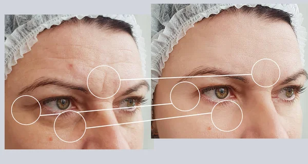 Woman Face Wrinkles Treatment — Stock Photo, Image