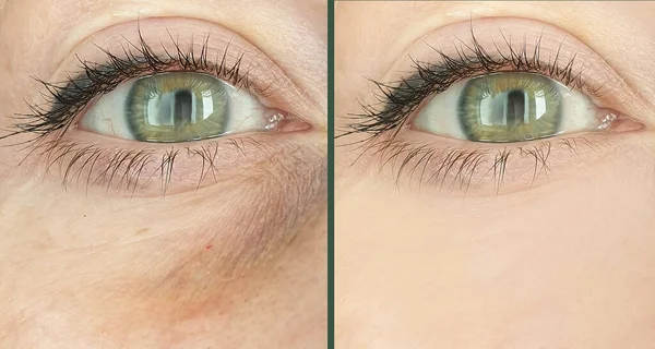 Женские Глаза Морщинки После Лечения — стоковое фото