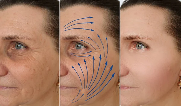 Woman Face Wrinkles Treatment — Stock Photo, Image