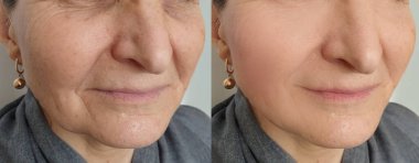 Kadın tedaviden önce ve sonra kırışıklıklarla karşılaşır