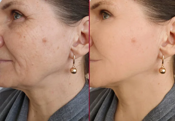 woman face wrinkles before and after treatment