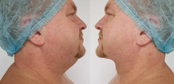 Man Double Chin Treatment — Stok Foto