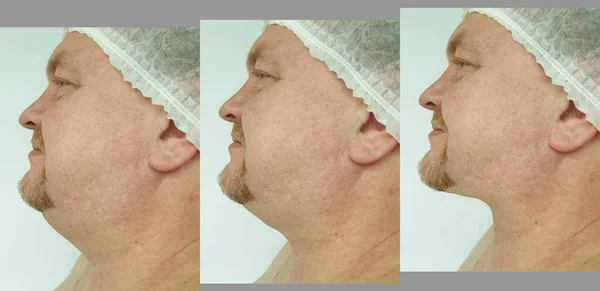 Man Double Chin Treatment — Stok Foto