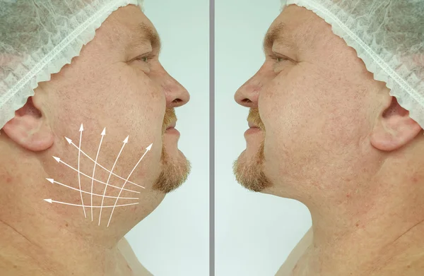 Man Double Chin Treatment — Stok Foto