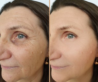 Kadın tedaviden önce ve sonra kırışıklıklarla karşılaşır