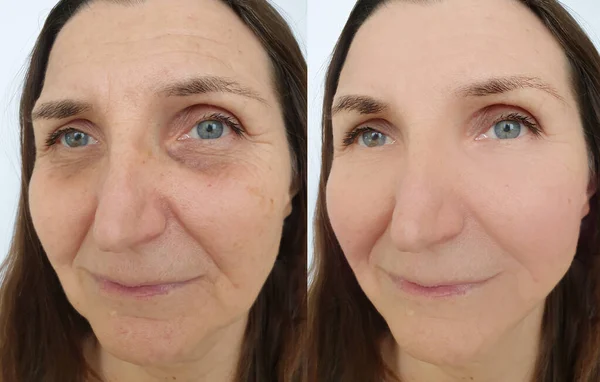 woman face wrinkles before and after treatment