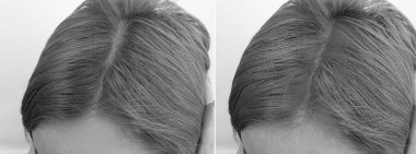 Tedavi öncesi ve sonrası kadın saçı kelliği