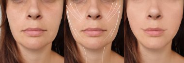 Kadın tedavi öncesi ve sonrası yüz gerdirme