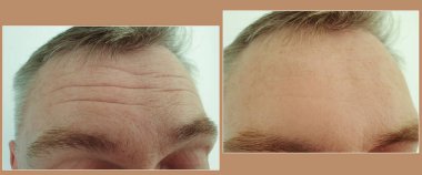 erkek alnında tedavi öncesi ve sonrası kırışıklıklar