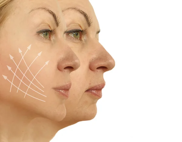 woman double chin before and after treatment