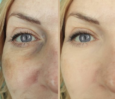 Kadın tedaviden önce ve sonra kırışıklıklarla karşılaşır