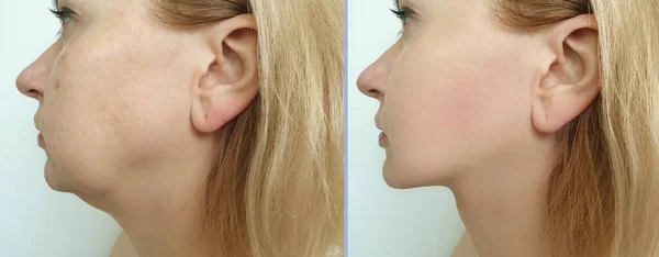 woman double chin before and after treatment