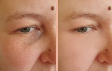 Kadın tedaviden önce ve sonra kırışıklıklarla karşılaşır