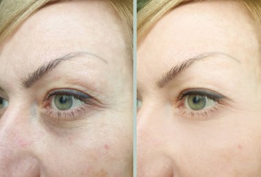  Kadın tedaviden önce ve sonra kırışıklıklarla karşılaşır