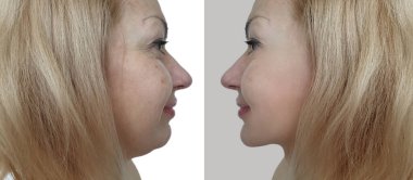 woman face double chin before and after treatment clipart