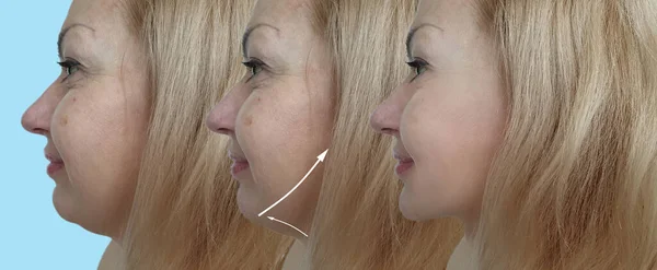 woman face double chin before and after treatment