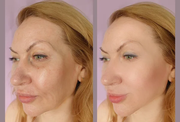 Wanita Wajah Keriput Sebelum Dan Setelah Pengobatan — Stok Foto