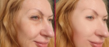 Kadın tedaviden önce ve sonra kırışıklıklarla karşılaşır