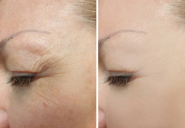 Woman Eyes Wrinkles Treatment — Stock Photo, Image