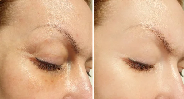 woman eyes wrinkles before and after treatment