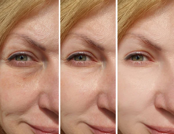 woman eyes wrinkles before and after treatment