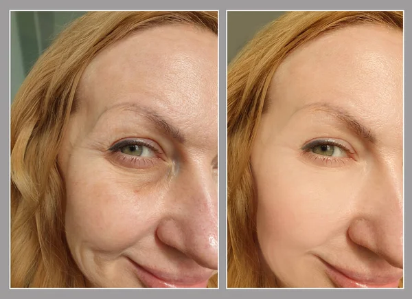 woman eyes wrinkles before and after treatment