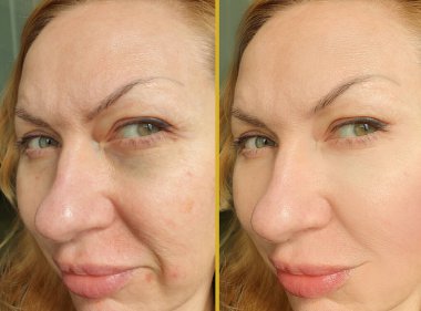 Kadın gözü tedaviden önce ve sonra kırışıyor.