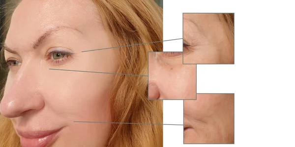 woman face wrinkles before and after treatment collage