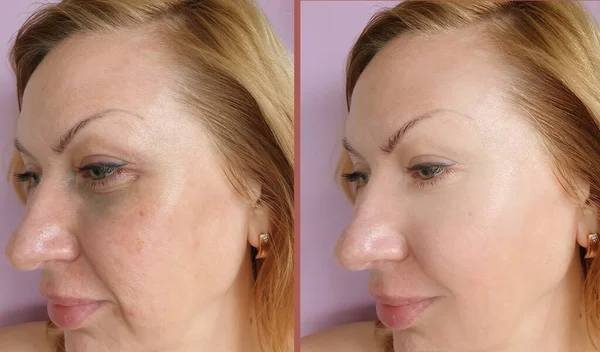 woman face wrinkles before and after treatment collage