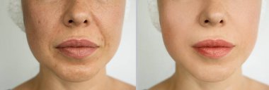 Kadın tedaviden önce ve sonra kırışıklıklarla karşılaşır