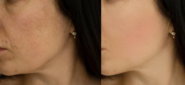 Kadın tedaviden önce ve sonra kırışıklıklarla karşılaşır