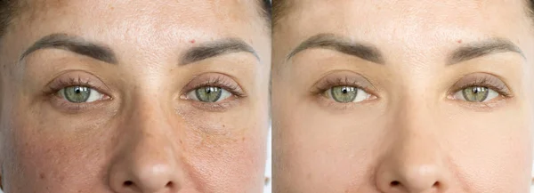 Woman Eyes Wrinkles Treatment — Stock Photo, Image