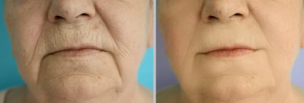 Woman Face Wrinkles Treatment — Stock Photo, Image