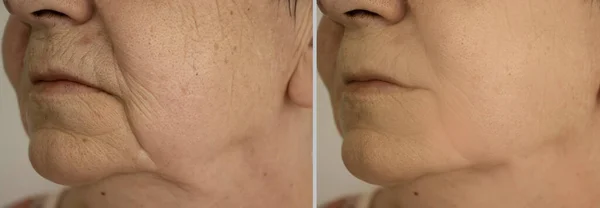 woman face wrinkles before and after treatment