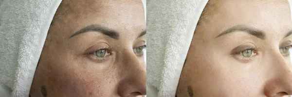 Жінка Очі Зморшки Після Лікування — стокове фото