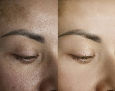 Kadın gözü tedaviden önce ve sonra kırışıyor.