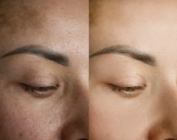 Γυναίκα Μάτια Ρυτίδες Πριν Και Μετά Θεραπεία — Φωτογραφία Αρχείου