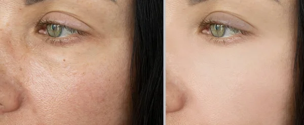 Woman Eyes Wrinkles Treatment — Stock Photo, Image