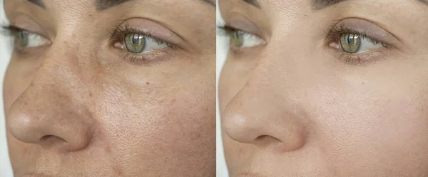 woman eyes wrinkles before and after treatment