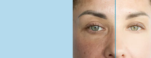 治療前と治療後の女性の目のしわ — ストック写真