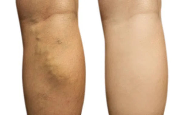 Жіноча Нога Варикозне Розширення Вен Після Лікування — стокове фото
