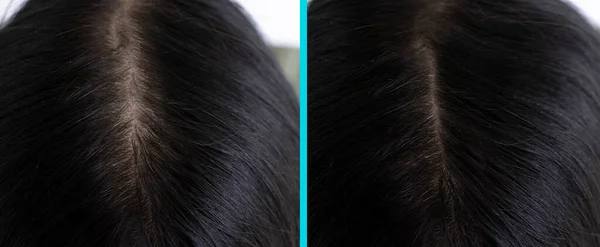 治療前と治療後の女性の頭毛のバランス — ストック写真