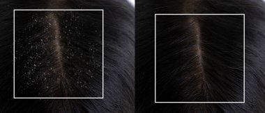 Tedaviden önce ve sonra saçında kepek var.