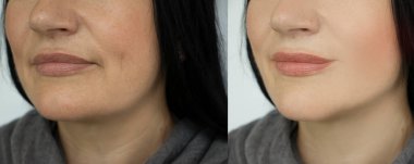 Kadın tedaviden önce ve sonra kırışıklıklarla karşılaşır