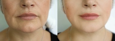 Kadın tedaviden önce ve sonra kırışıklıklarla karşılaşır