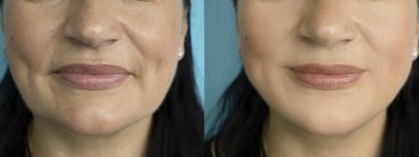 Kadın tedaviden önce ve sonra kırışıklıklarla karşılaşır