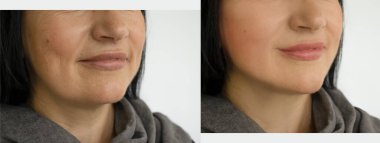 Kadın tedaviden önce ve sonra kırışıklıklarla karşılaşır