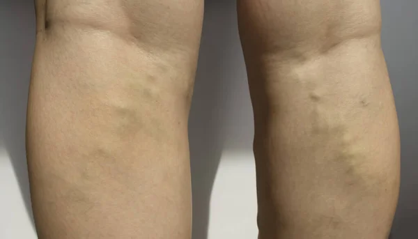 Γυναικεία Πόδια Κιρσούς Πρόβλημα — Φωτογραφία Αρχείου