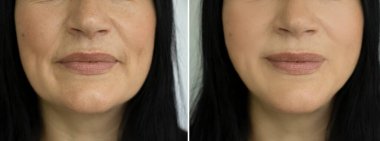 Kadın tedaviden önce ve sonra kırışıklıklarla karşılaşır