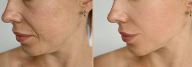 Kadın tedaviden önce ve sonra kırışıklıklarla karşılaşır